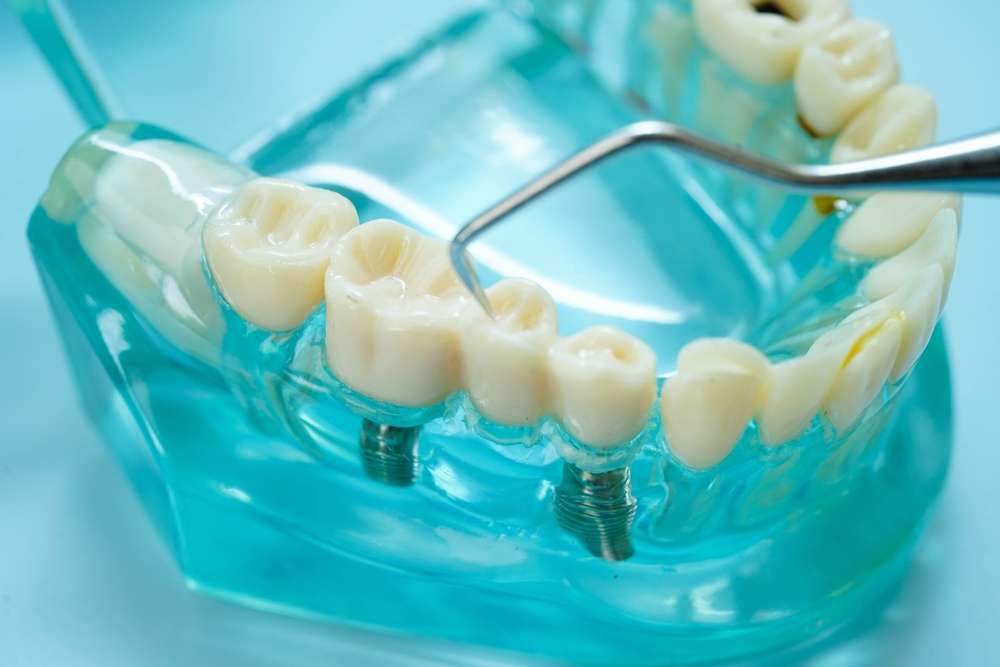 cost of dental implants in Ontario