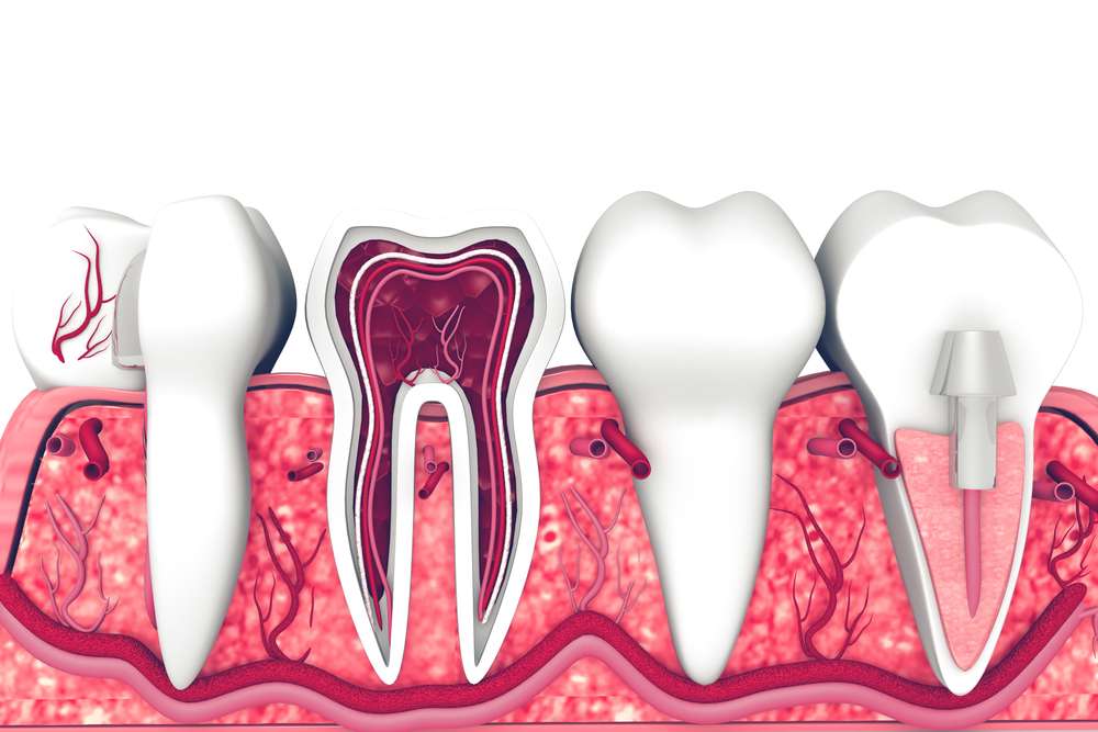 how to avoid root canal