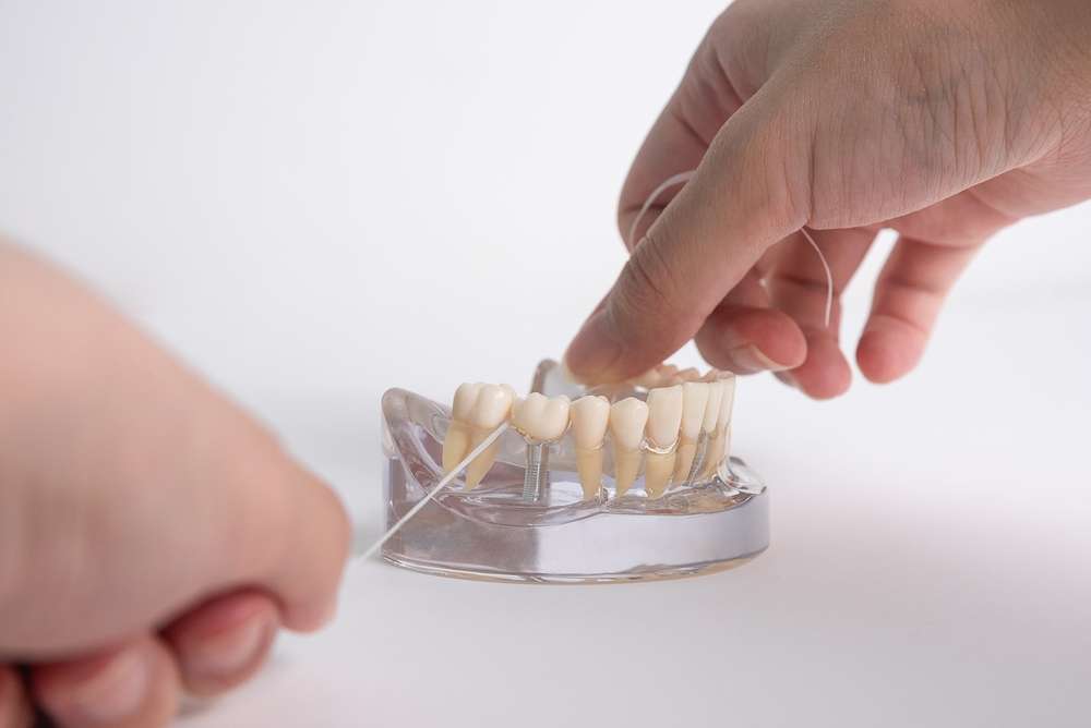 tooth implant vs dental bridge